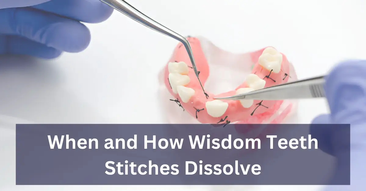 When and How Wisdom Teeth Stitches Dissolve