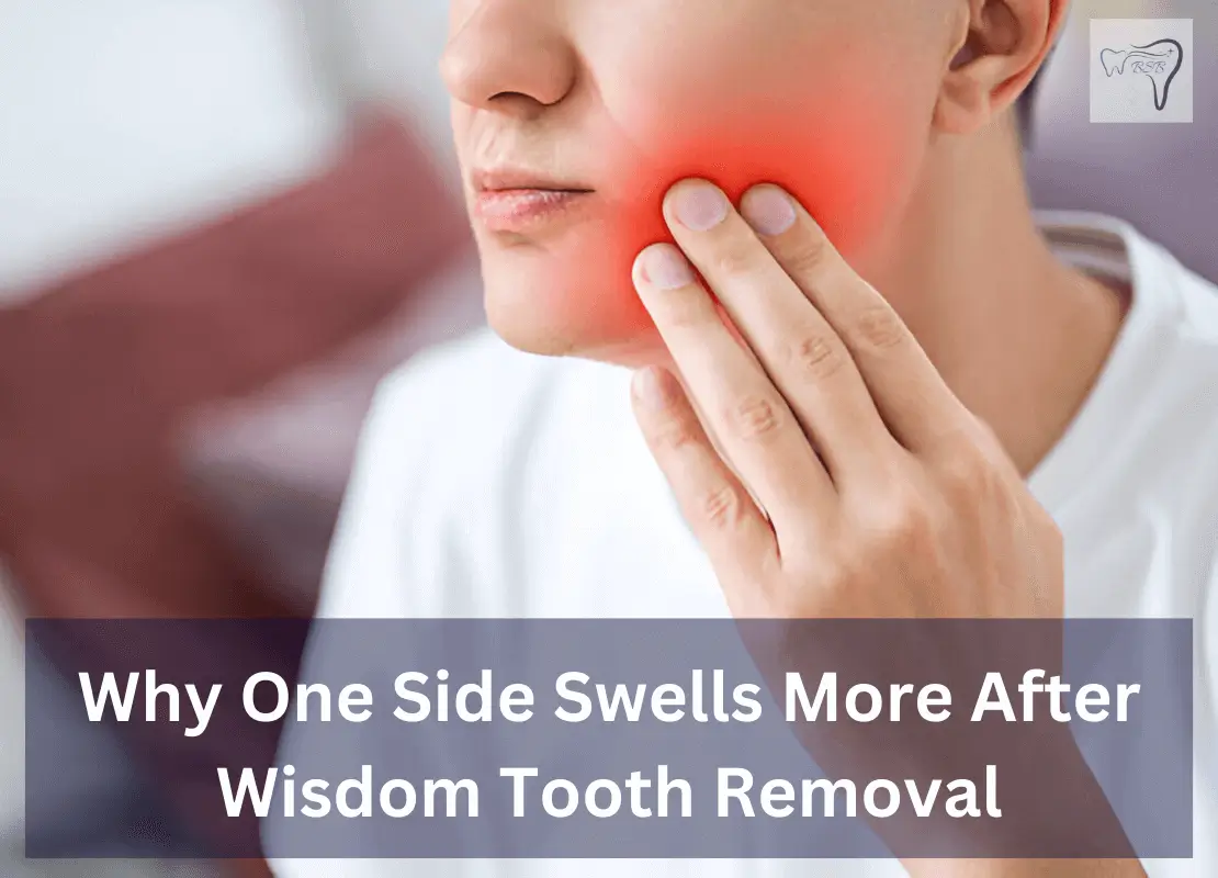 Why One Side Swells More After Wisdom Tooth Removal