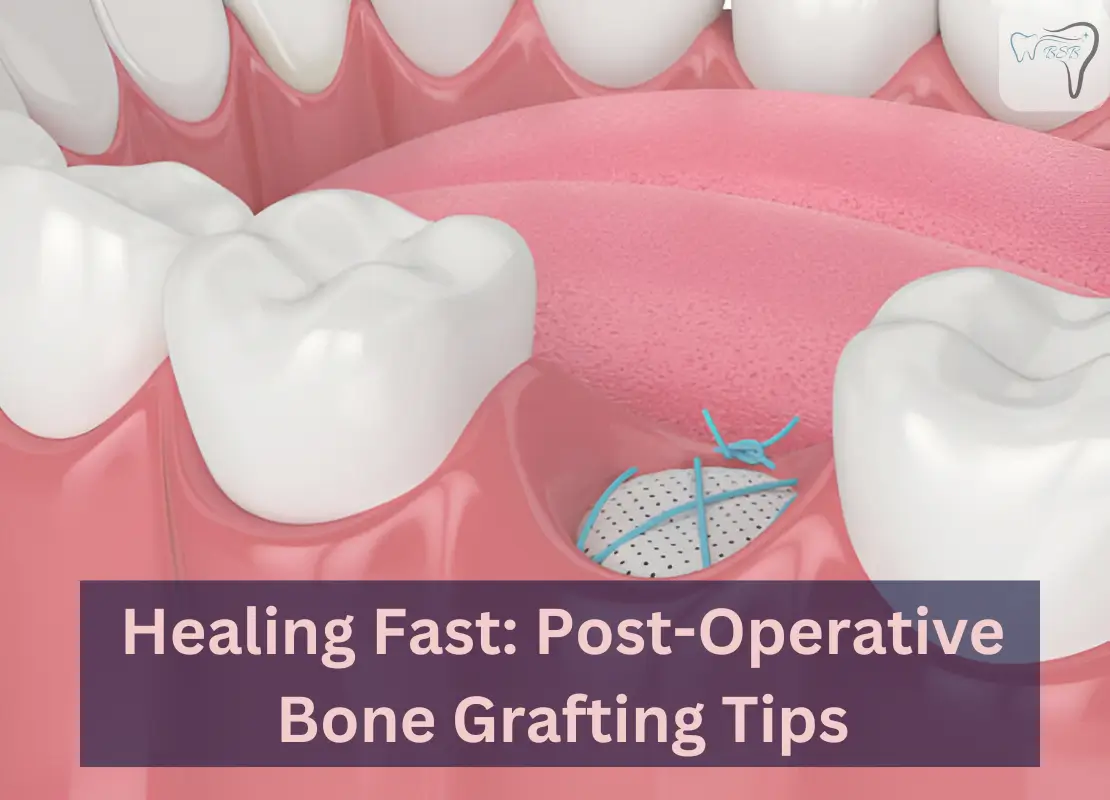 Healing Fast: Post-Operative Bone Grafting Tips