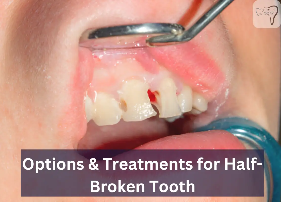 Options & Treatments for Half-Broken Tooth