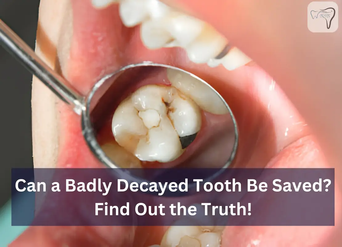 Can a Badly Decayed Tooth Be Saved? Find Out the Truth!