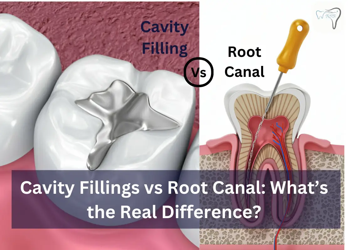 Cavity Fillings vs Root Canal: What's the Real Difference?