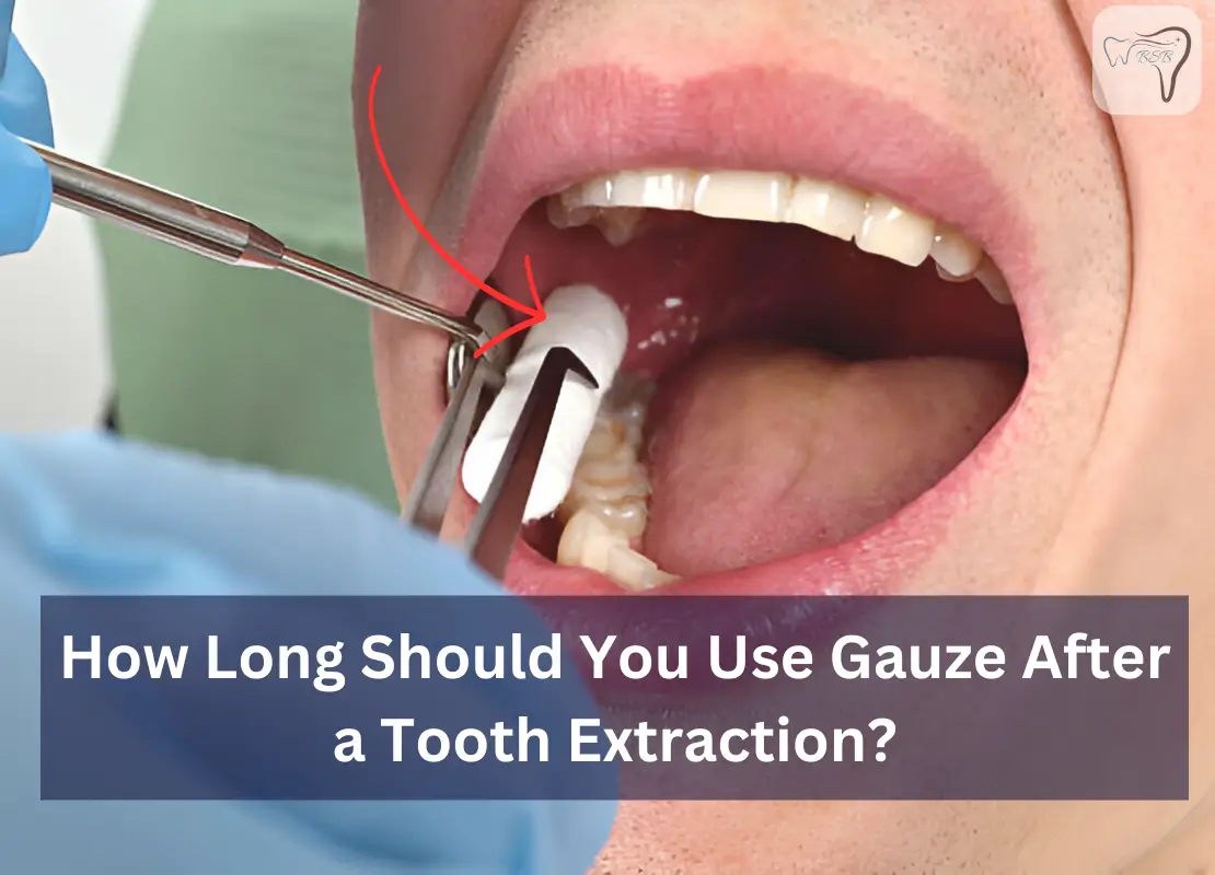 How Long Should You Use Gauze After a Tooth Extraction?