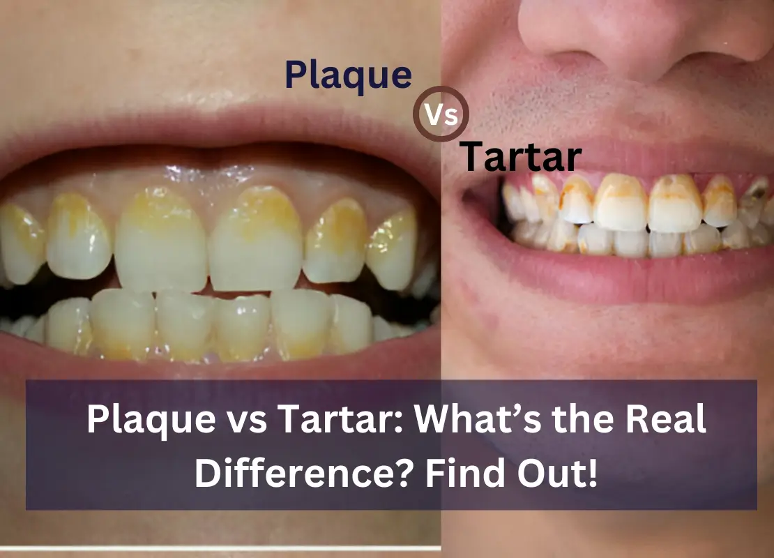 Plaque vs Tartar: What’s the Real Difference? Find Out!