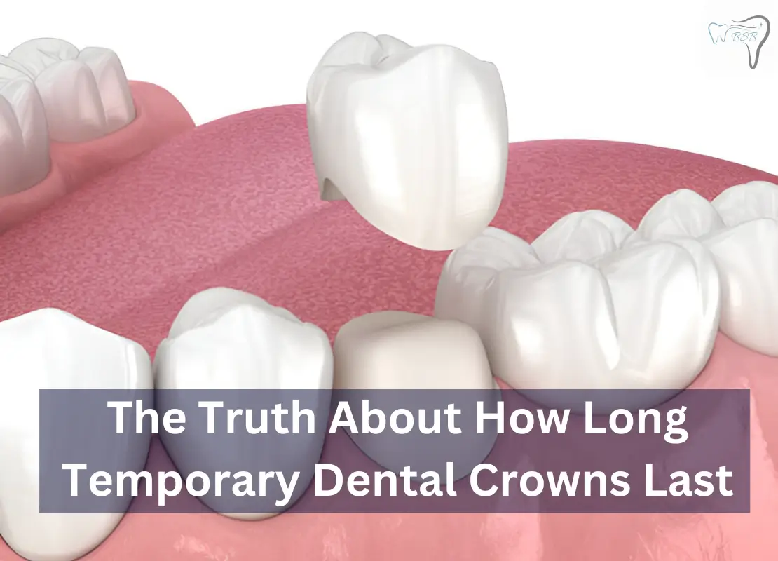 The Truth About How Long Temporary Dental Crowns Last