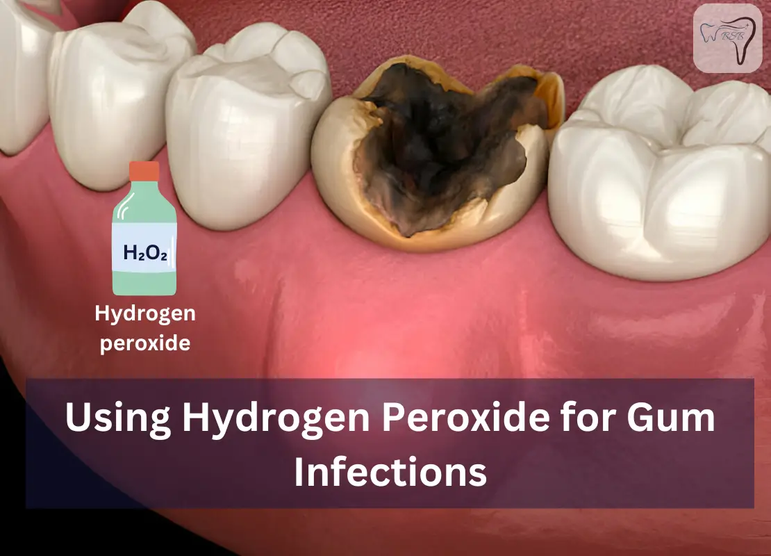 Using Hydrogen Peroxide for Gum Infections